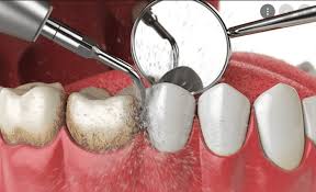 Limpieza Dental