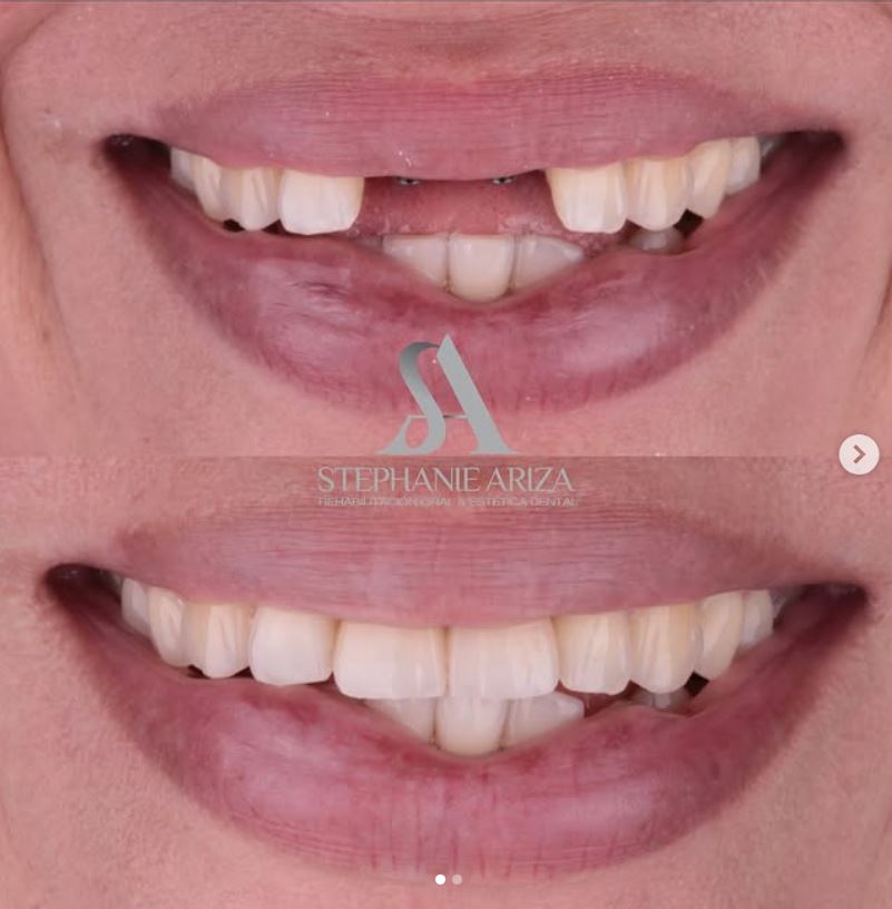 Implantes Dentales 1